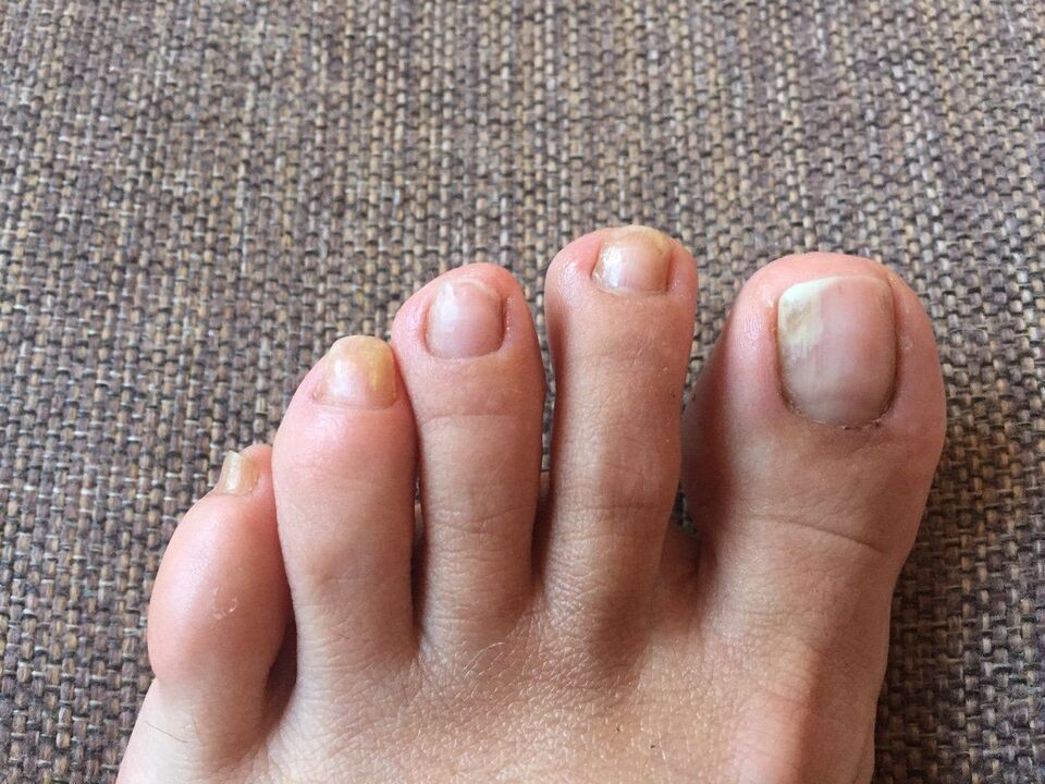 Causas do fungo das unhas dos pés